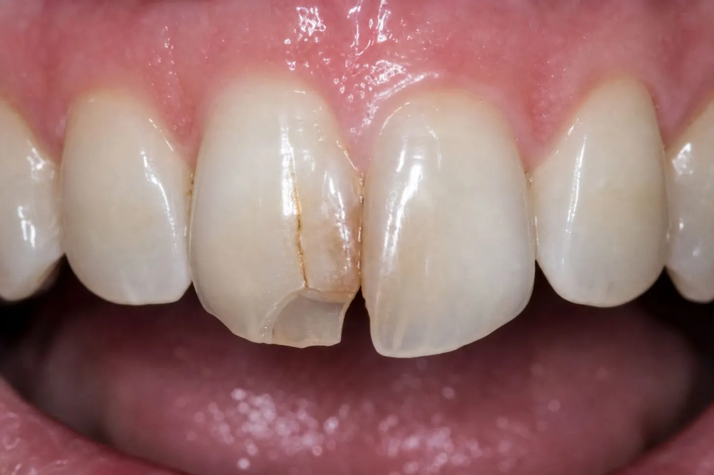 Front Tooth Restoration — before treatment