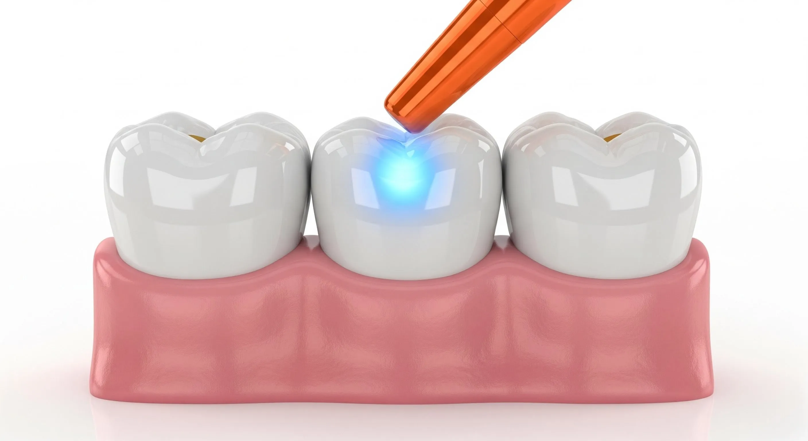 Composite Fillings Cost and Pricing Information in Concord
