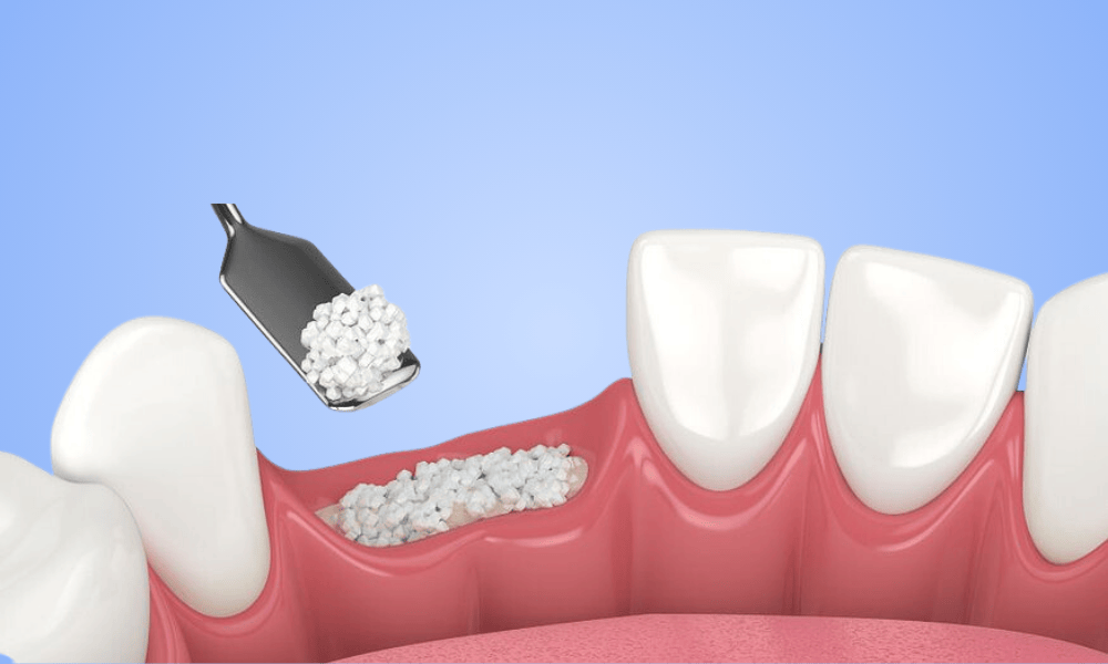 Why Choose Bone Grafting in Concord?