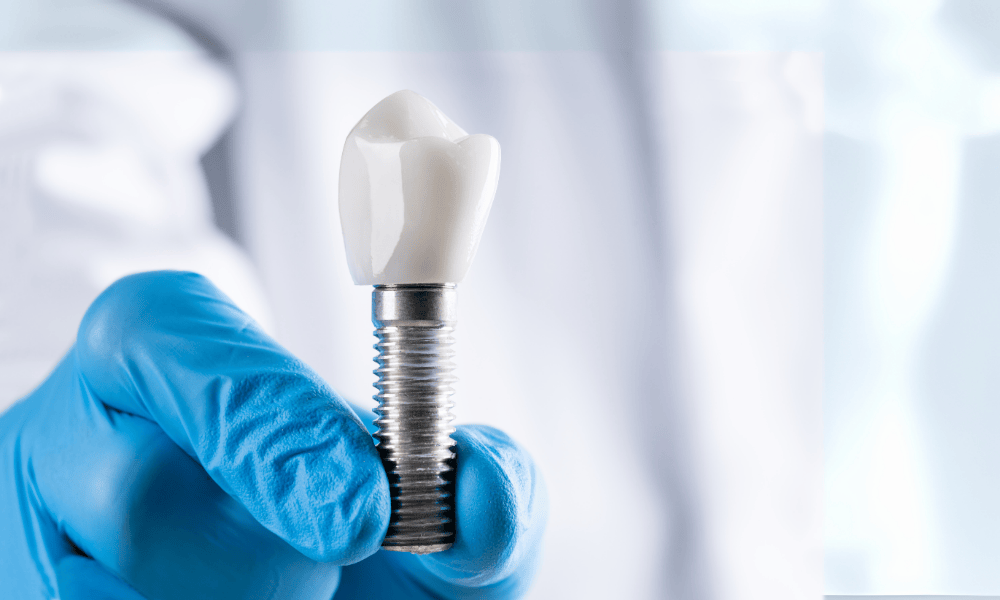 Why Choose Dentist in Concord for Dental Implants?