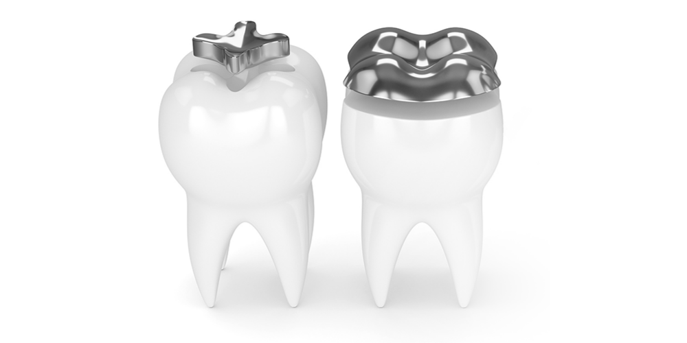 What are Inlay and Onlay Restorations?