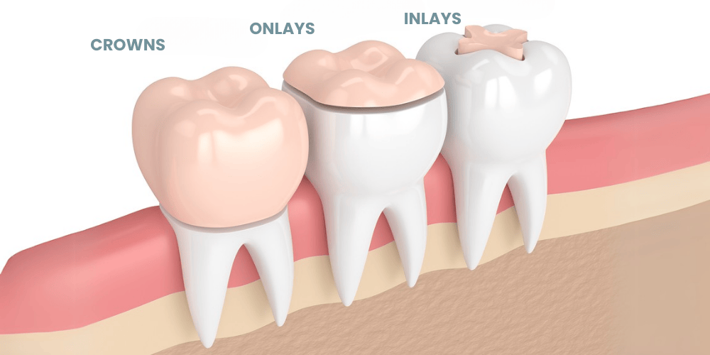 Inlay and Onlay vs. Crowns