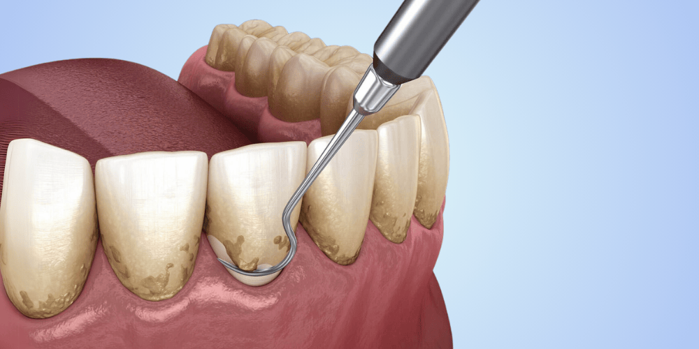 Periodontal Services We Offer