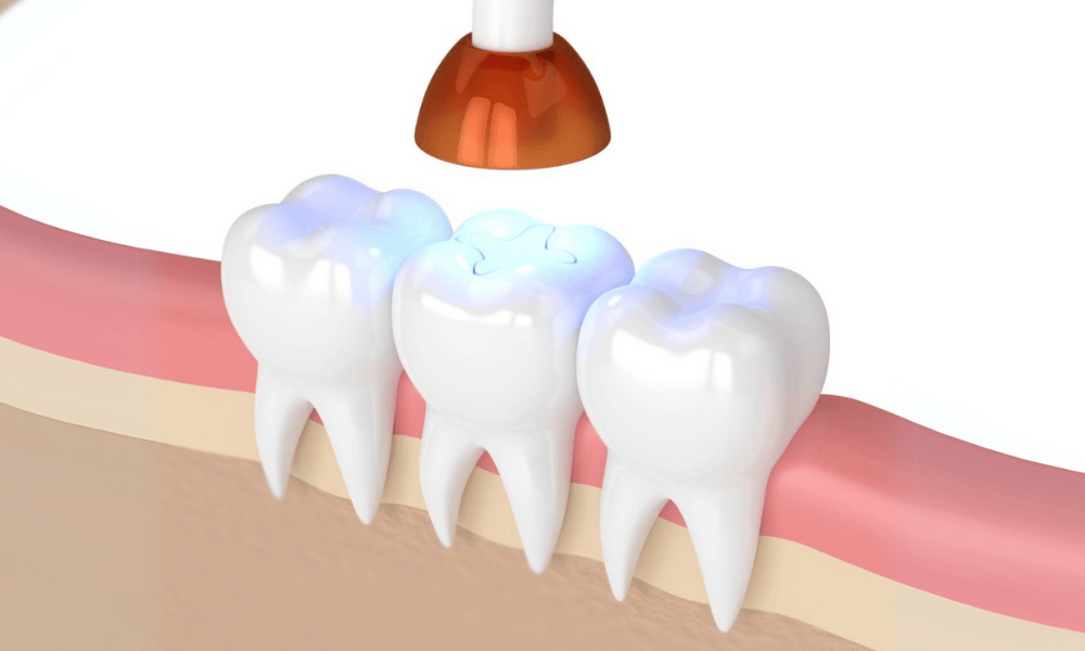 Composite Fillings Cost and Pricing Information in Concord