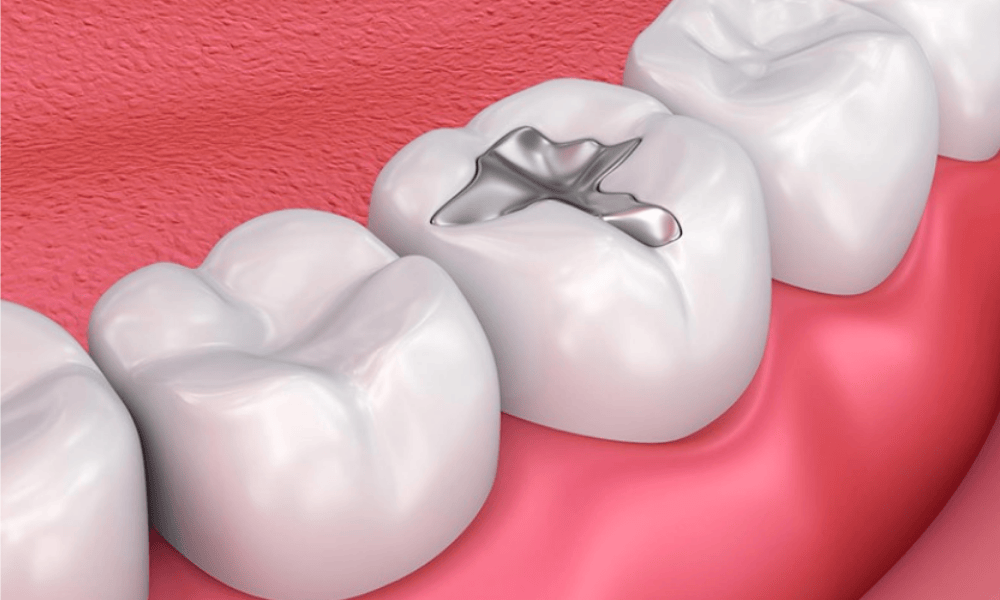 Silver vs. Composite Fillings